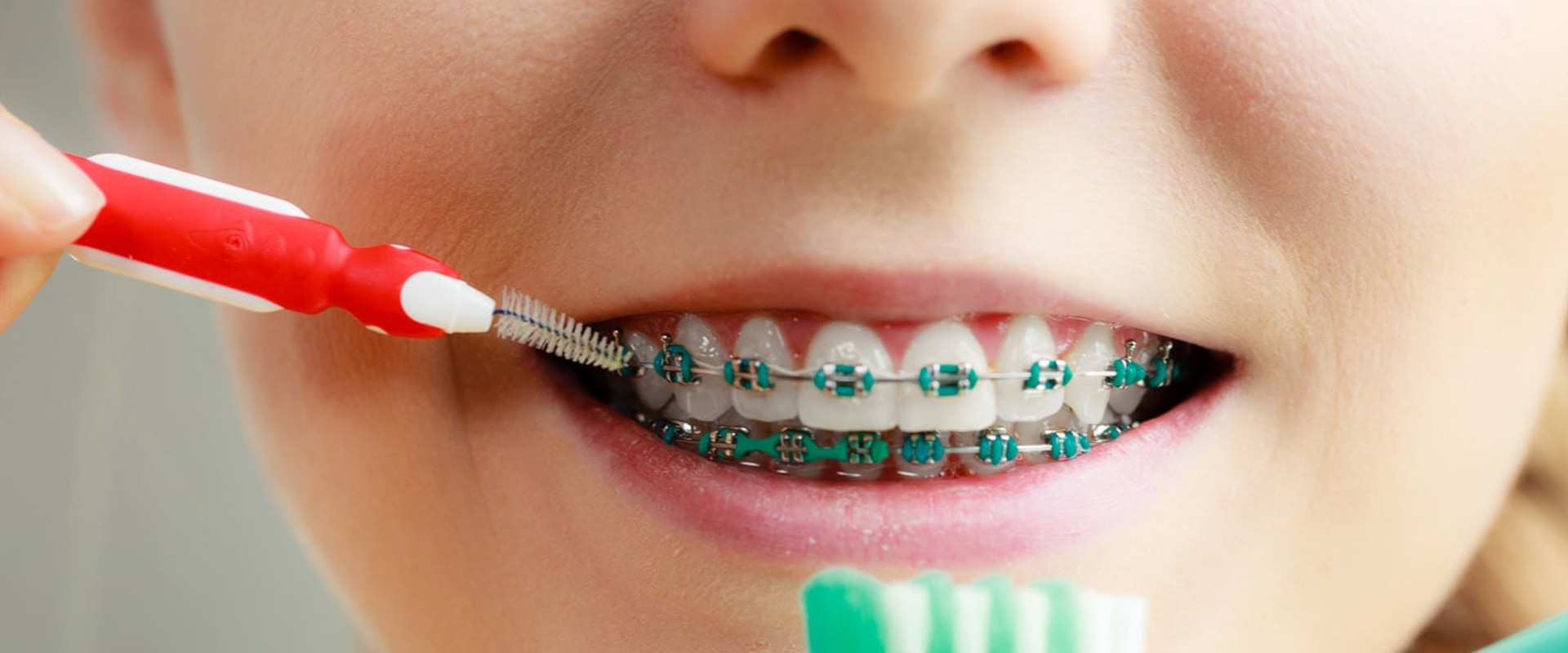 do-orthodontists-clean-teeth-an-expert-s-guide