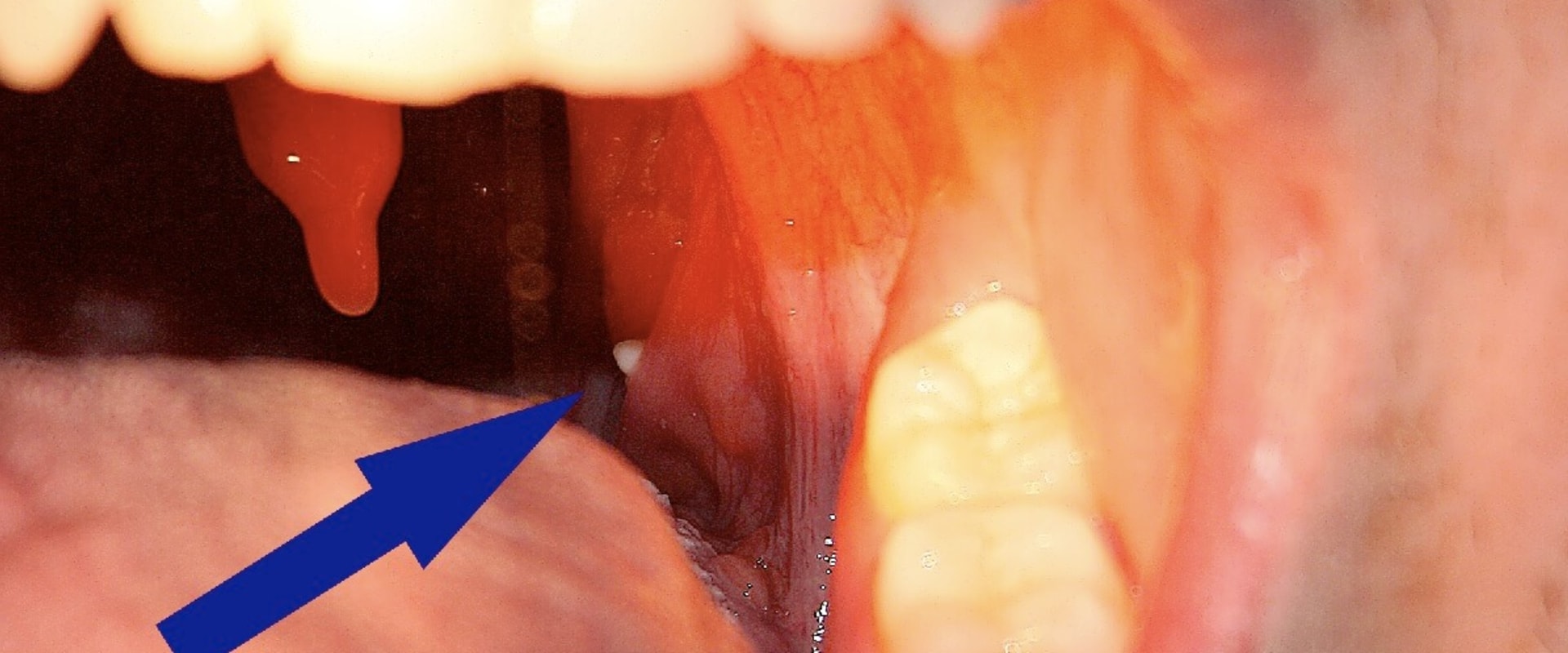 Do Dentists Help with Tonsil Stones?