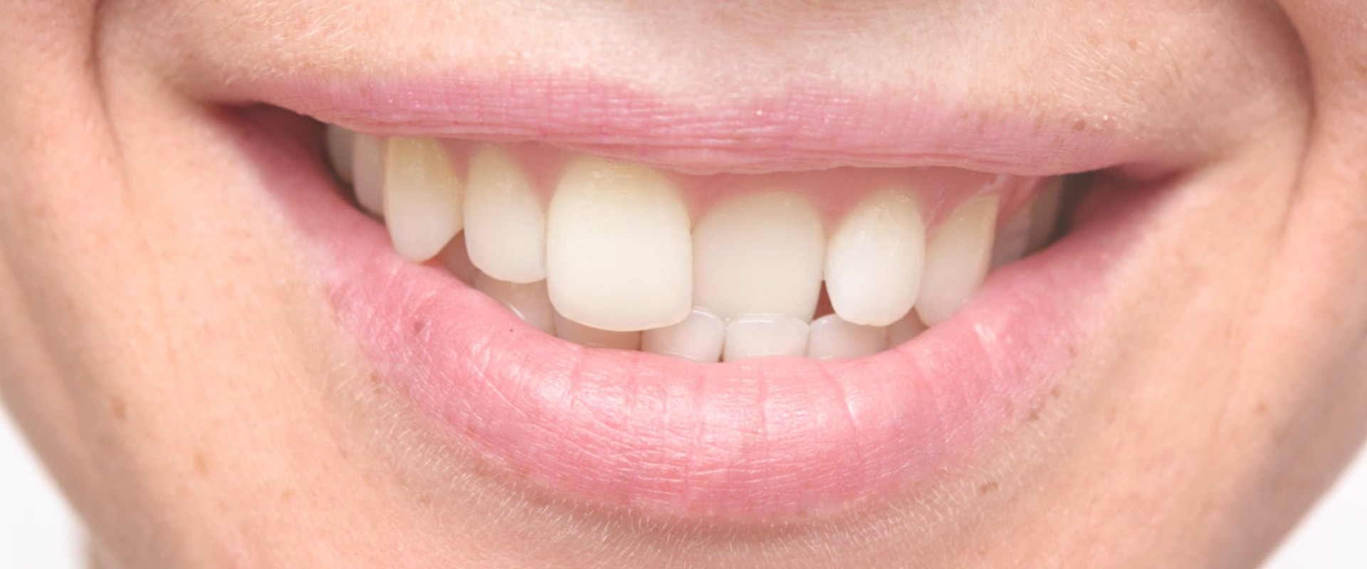 Straighten Teeth Without Braces Exploring Alternatives