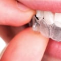 What Are the Alternatives to Braces for Straightening Teeth?