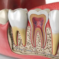 Do dentist pull teeth that are infected?