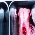 Why don t all dentists do root canals?