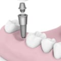 Which Dentist is the Best for Dental Implants?