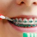 Do Orthodontists Clean Teeth? An Expert's Guide