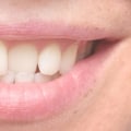 Is there another way to straighten teeth without braces?