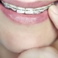 How Much Does it Cost to Get Braces?