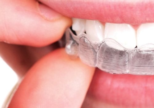 What Are the Alternatives to Braces for Straightening Teeth?