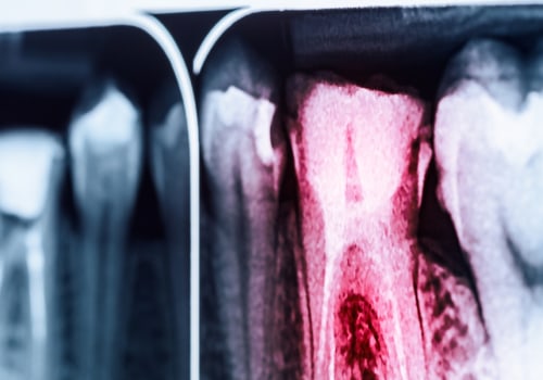 Why don t all dentists do root canals?