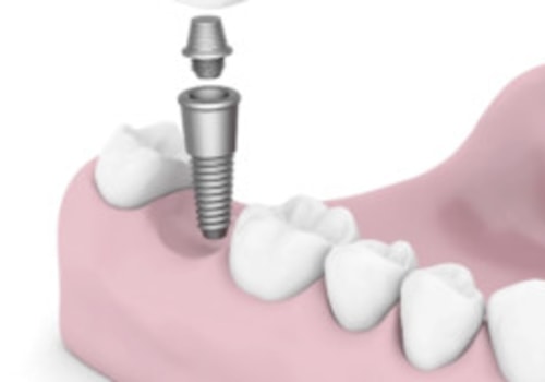 Which dentist does implants?