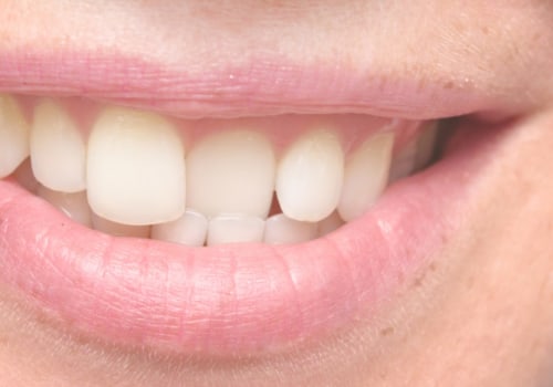 Can orthodontists straighten teeth without braces?