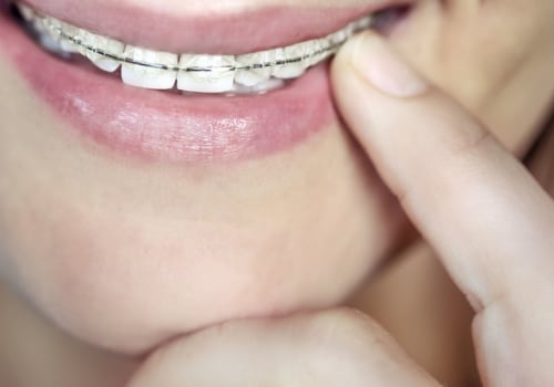 How Much Does it Cost to Get Braces?